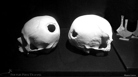 Ancient trepanation surgery skulls on exhibit at the Larco Museum, Lima, Peru