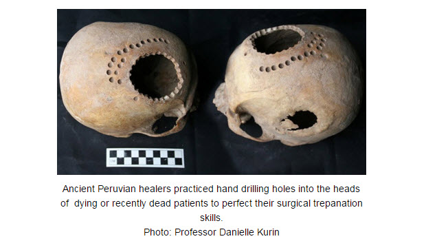 The practiced craft of ancient Peruvian skull surgery