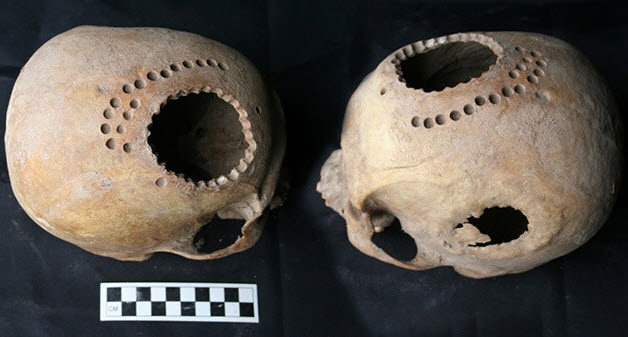 Ancient Peruvian healers practiced hand drilling holes into the head of a dying or recently dead patient to perfect their surgical trepanation skills